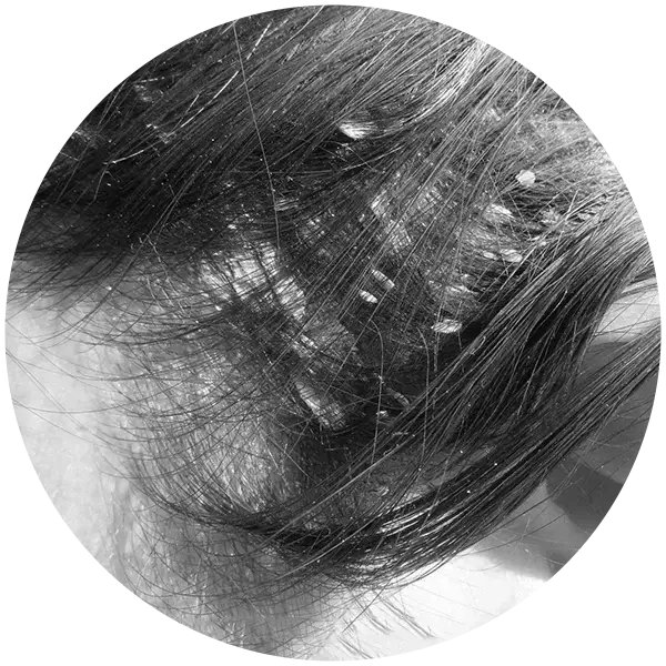 HairShield-Blue-Shampoo-Flaky-Scalp